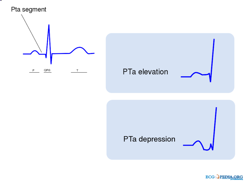 PTa elevation and PTa depression