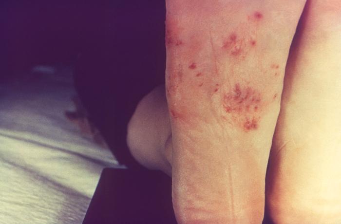Patient’s right foot displayed a rash that had been diagnosed as tinea pedis, caused by the dermatophytic fungal organism, Trichophyton mentagrophytes. From Public Health Image Library (PHIL). [1]