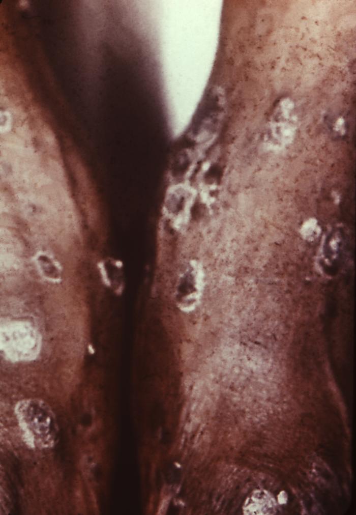 This patient presented with areas of facial alopecia due to secondary syphilis. The second stage starts when one or more areas of the skin break into a rash that appears as rough, red or reddish brown spots both on the palms of the hands and on the bottoms of the feet. Even without treatment, rashes clear up on their own. Adapted from CDC