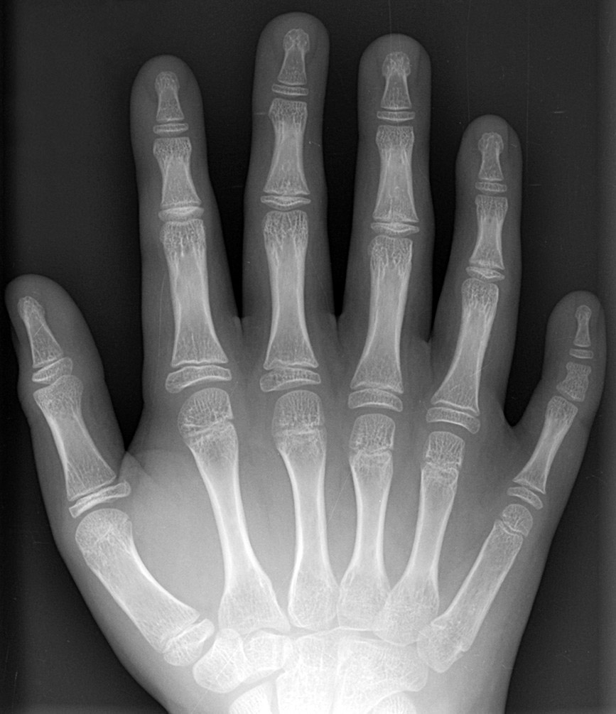 Ellis-Van Creveld syndrome Right hand with mid-ray duplication