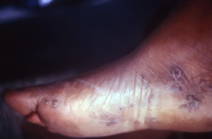 This patient presented with secondary syphilitic lesions of the face. The second stage starts when one or more areas of the skin break into a rash that appears as rough, red or reddish brown spots both on the palms of the hands and on the bottoms of the feet. Even without treatment, rashes clear up on their own. Adapted from CDC
