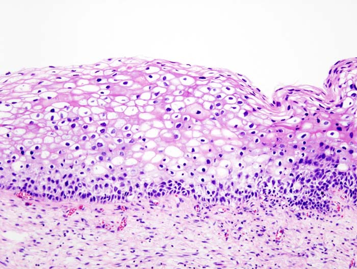 File:Cervical intraepithelial neoplasia (2) koilocytosis.jpg