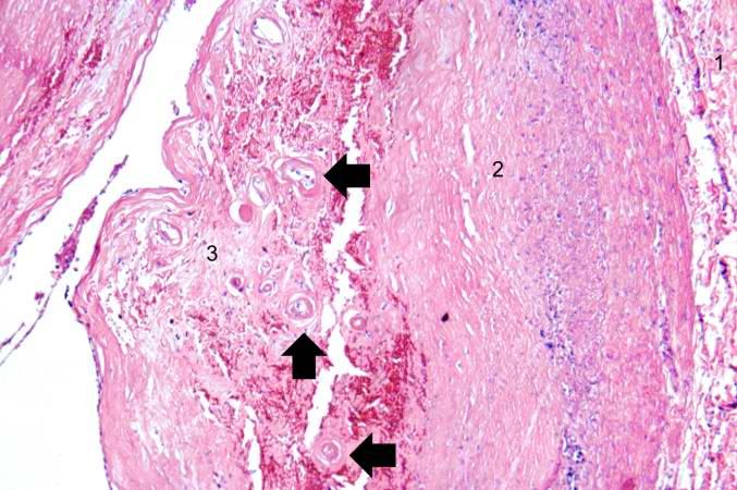 This is a higher-power photomicrograph of another region of the vessel wall. The adventitia (1) and the media (2) contain inflammatory cells. The recanalized portion of the vessel (3) is composed of fibrous connective tissue and contains numerous small blood vessels (arrows).
