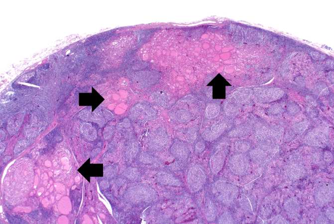 This is a higher-power photomicrograph of thyroid from this case. Note the large number of blue-staining inflammatory cells in this tissue. These cells appear to be forming germinal centers. Some residual thyroid gland tissue can be seen in this section (arrows).