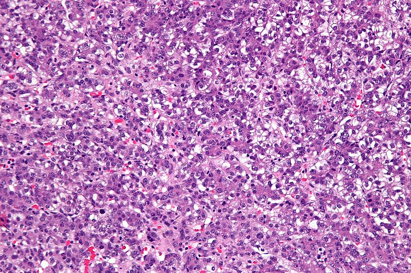 High magnification micrograph of a hepatoblastoma, a type of liver cancer found in infants and young children. H&E stain.[7]