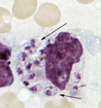 Leishmania tropica amastigotes from an impression smear of a biopsy specimen from a skin lesion. In this figure, amastigotes are being freed from a rupturing macrophage. Patient had traveled to Egypt, Africa, and the Middle East. Based on culture in NNN medium, followed by isoenzyme analysis, the species was identified as L. tropica. Adapted from CDC