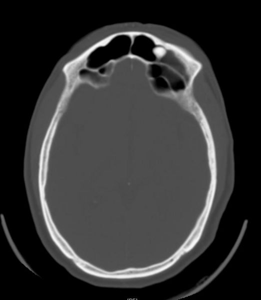 CT scan demonstrating a left frontal sinus osteoma