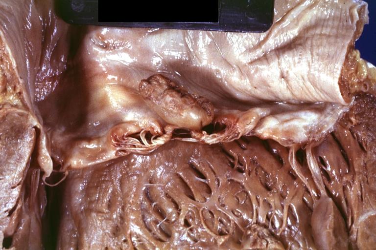 Papillary Muscle Infarct with Rupture: Gross, fixed tissue, but good color. An outstanding photo of ruptured head of posterior papillary muscle with entangled chordae