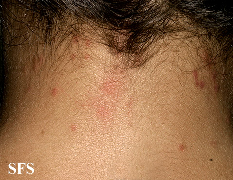 Pediculosis capitis. Adapted from Dermatology Atlas.[12]