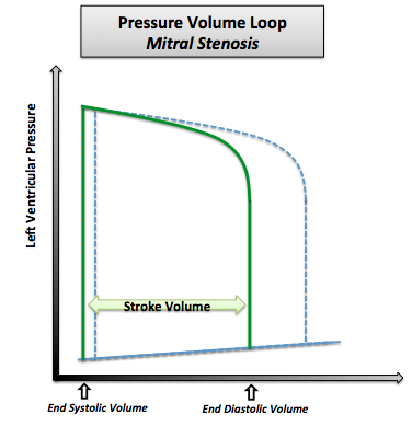 Pressure-volume loop in mitral stenosis. Note that the normal pressure volume loop is in dotted line.