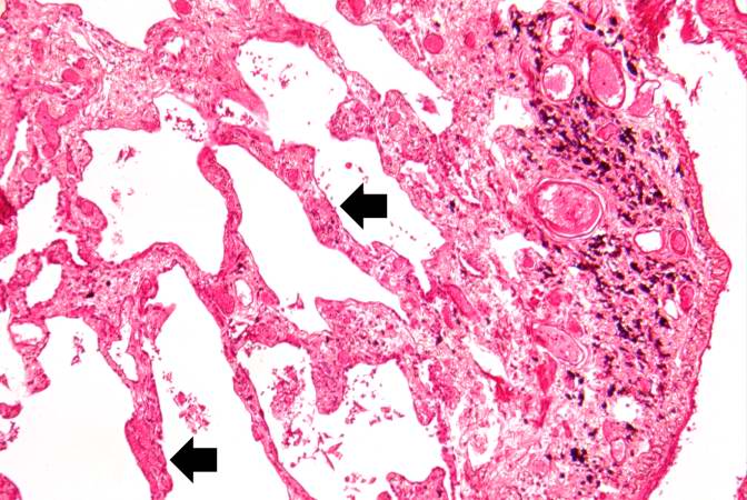 This is another high-power photomicrograph of lung section showing the thickening of the alveolar septa (arrows) and accumulations of black anthracotic pigment.