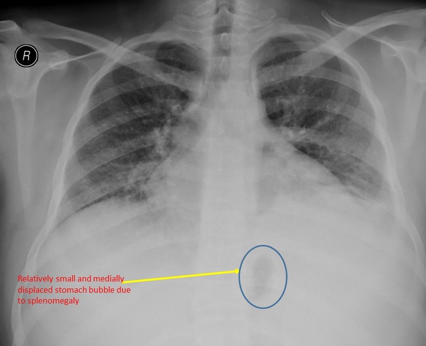 File:Splenic abscess chest x-ray.jpg