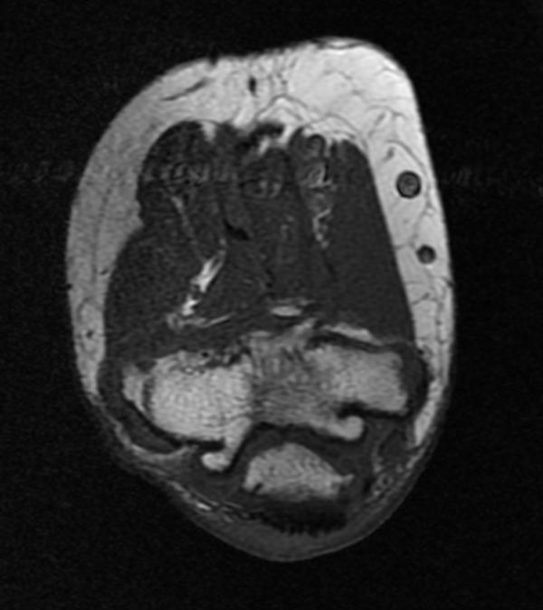 File:Ulnar nerve entrapment MRI 001.jpg