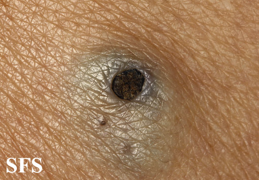 Warty dyskeratoma. Adapted from Dermatology Atlas.[8]