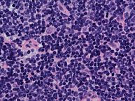 Mantle cell lymphoma. Notice the irregular nuclear contours of the medium-sized lymphoma cells and the presence of a pink histiocyte. By immunohistochemistry the lymphoma cells expressed CD20, CD5 and Cyclin D1 (high power view, H&E).