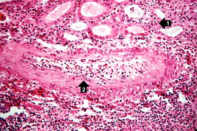 This high-power photomicrograph demonstrates the cellular infiltrate within the interstitium (1) and in the wall of the blood vessel (2).