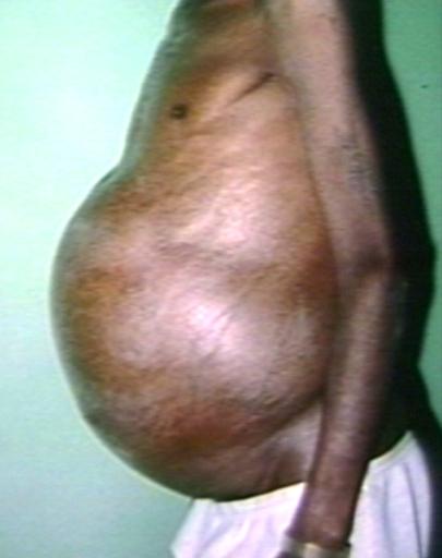 Ascites, the same patient, lateral view.