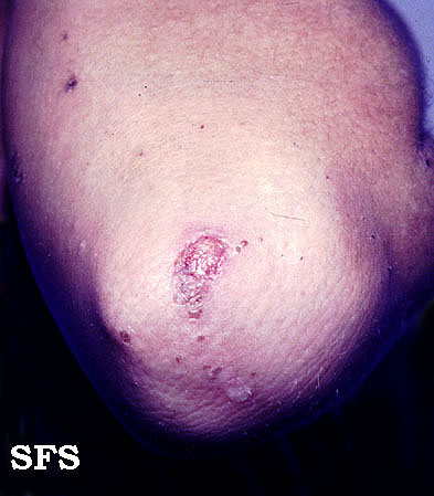 Epidermolysis bullosa simplex. Adapted from Dermatology Atlas.[1]