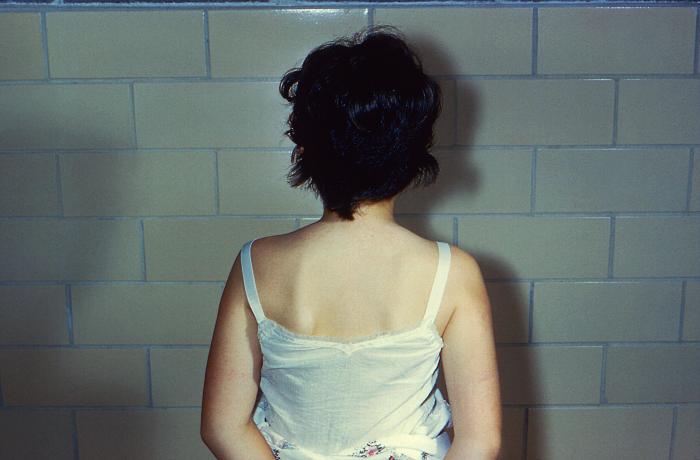 Image depicts the upper back and arms of a young girl who’d been diagnosed with a case of erythema infectiosum, or Fifth disease. From Public Health Image Library (PHIL). [2]