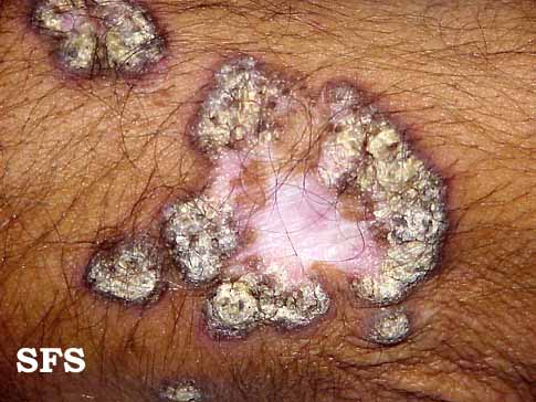 Lupus erythematosus chronicus verrucous. Adapted from Dermatology Atlas.[1]