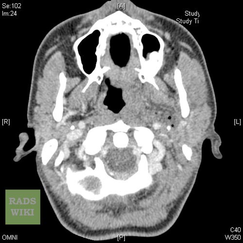 Peritonsillar abscess Image courtesy of RadsWiki and copylefted