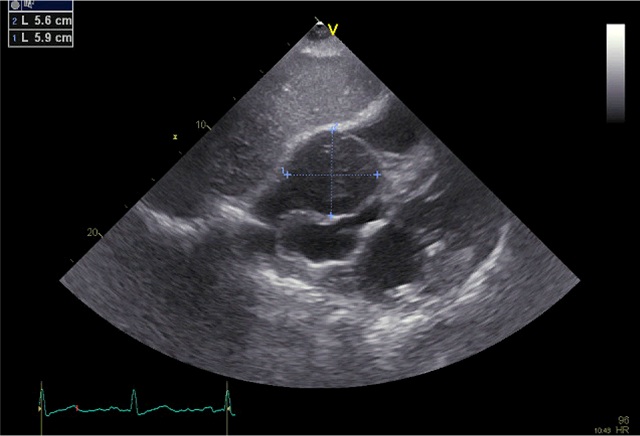 Transthoracic echocardiography subcostal view showing the cardiac mass adjacent to and compressing the right atrium