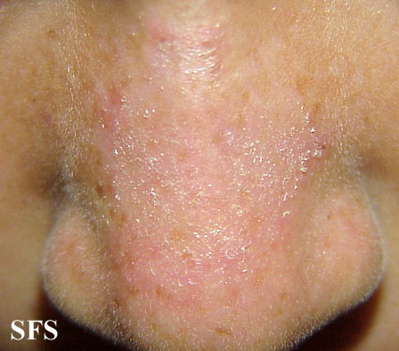 Tinea facei. Adapted from Dermatology Atlas.[3]