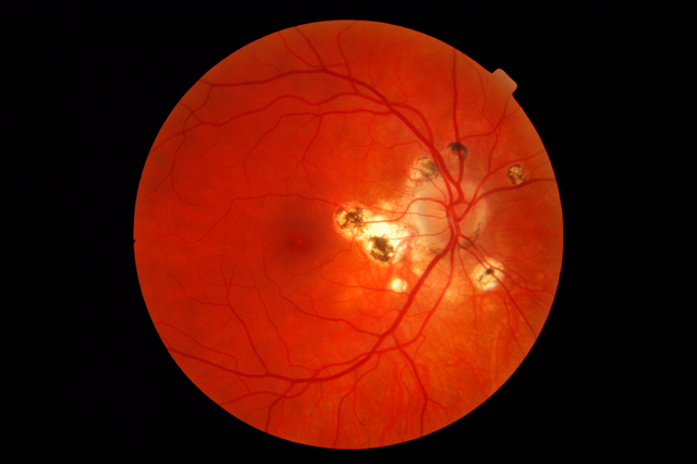 File:640px-Presumed ocular histoplasmosis syndrome-11192007.png