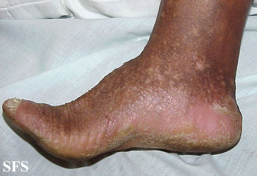 File:Darier's disease33.jpg
