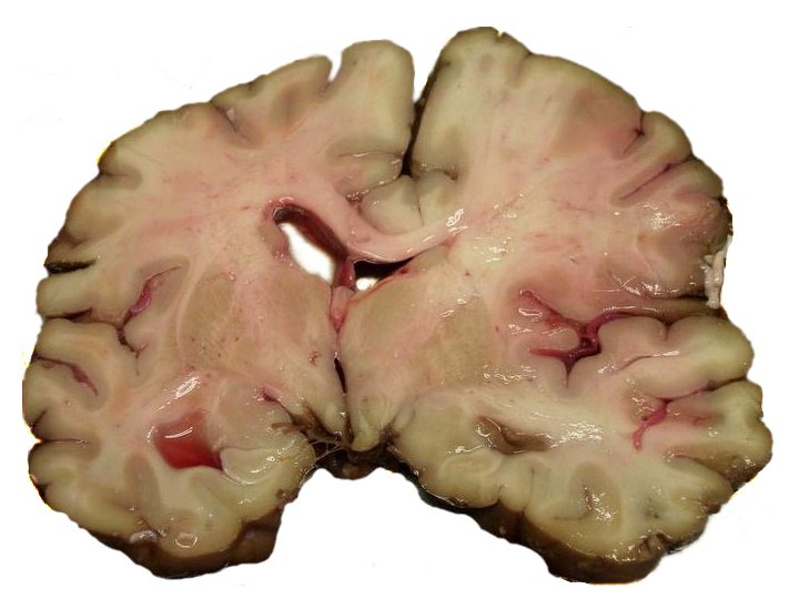 Autopsy of brain showing middle cerebral artery territory