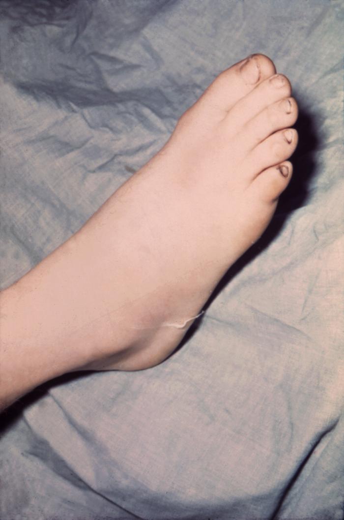 The foot of this patient is swollen due to gonococcal arthritis.Gonorrhea is the most frequently reported communicable disease in the U.S. Disseminated gonococcal infection is most often the cause of acute septic arthritis in sexually active adults, and the reason for most hospitalizations due to infective arthritis.Adapted from CDC