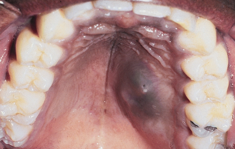 SALIVARY GLANDS: MUCOEPIDERMOID CARCINOMA OF PALATE. These tumors frequently are slightly raised, fluctuant, bluish discolorations of the palatal mucosa that are clinically thought to represent mucous escapereactions.