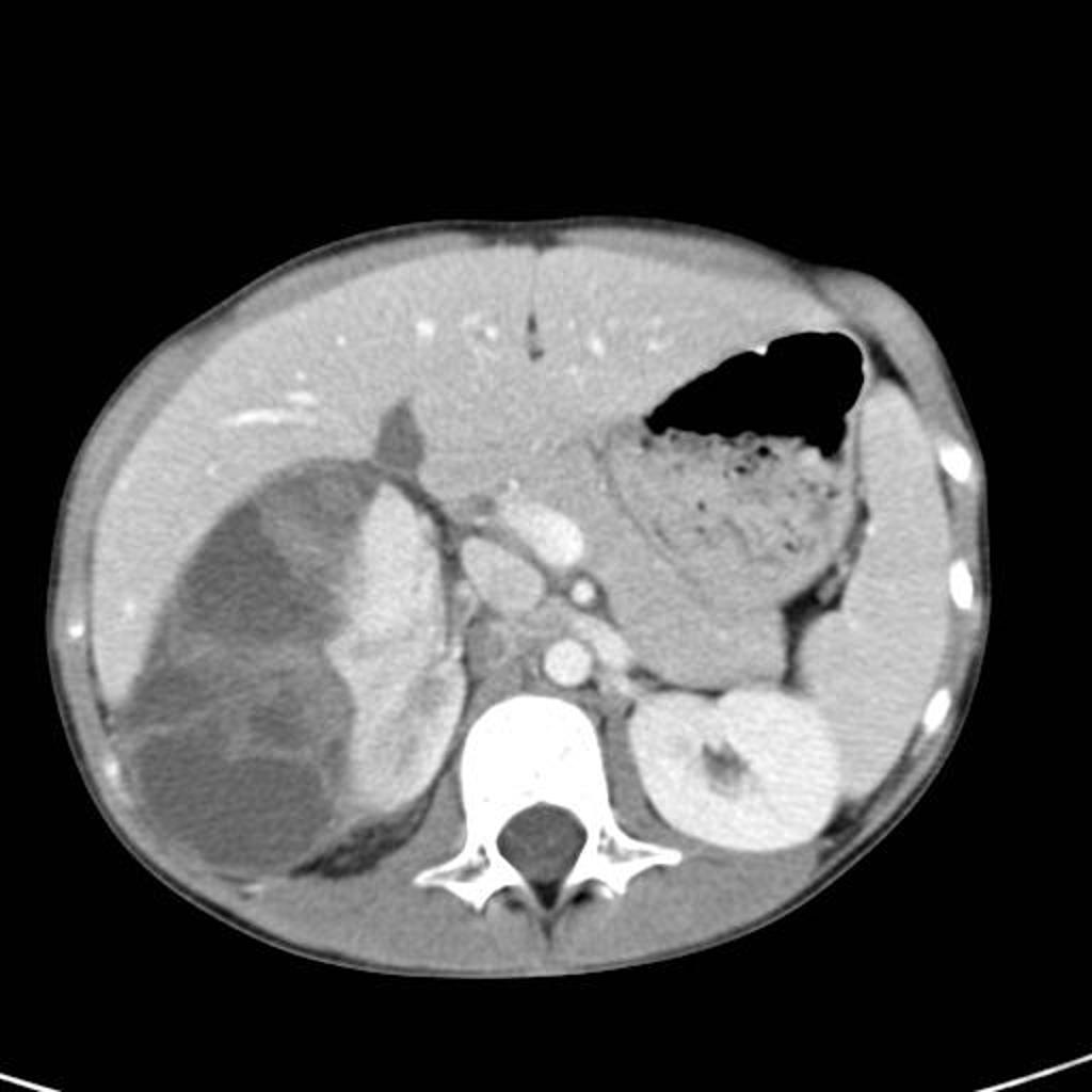 File:Wilms-tumour CT.jpg