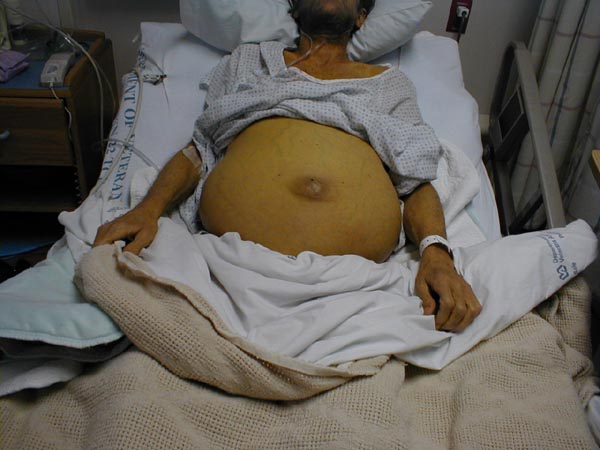 Ascites: Abdomen symetrically distended secondary to fluid buildup in peritoneal cavity. Note bulging flanks as fluid distributes to most dependent areas of abdomen. Skin is also yellowed due to hyperbilirubinemia