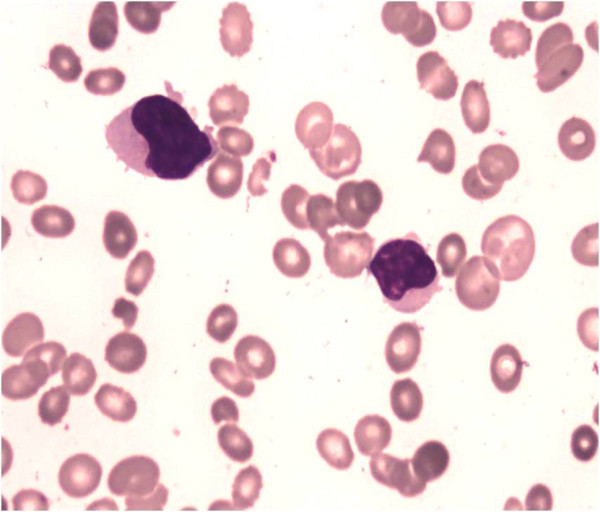 File:Hepatosplenic T cell lymphoma peripheral blood smear.jpg