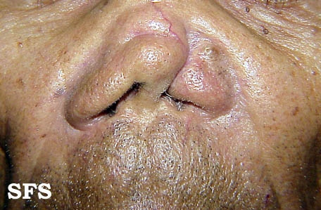 Mucocutaneous leishmaniasis. Adapted from Dermatology Atlas.[1]