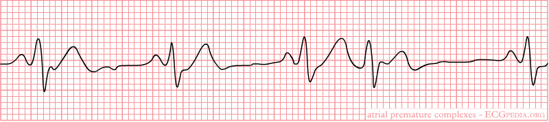 File:Premature Atrial Contraction 6.png