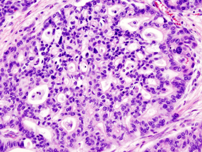 File:Pancreas adenocarcinoma - 2.jpg