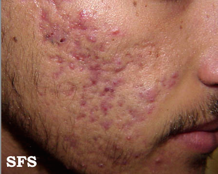 File:Acne 01.png