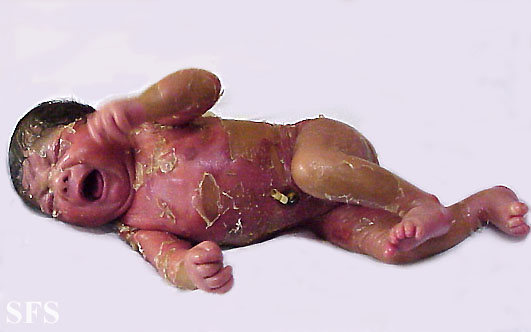 Collodin baby. Adapted from Dermatology Atlas.[1]