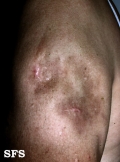 Lupus Erythematosus Profundu. Adapted from Dermatology Atlas.[30]