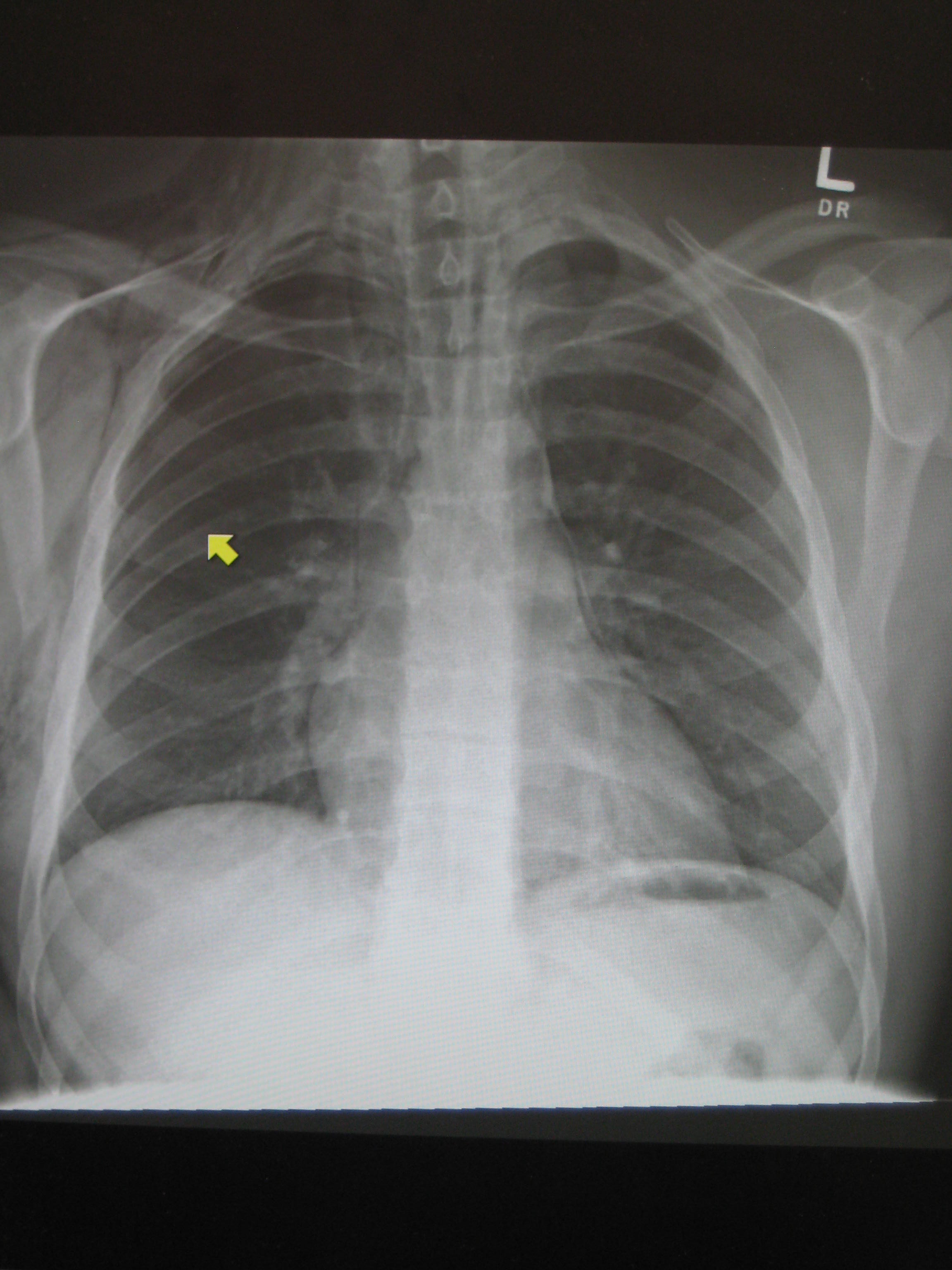 Pneumomediastinum and right sided pneumothorax post first rib fracture in a mountain biking accident.
