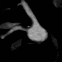 File:Renal artery stenosis 041.jpg