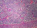 Adrenal neuroblastoma[7]