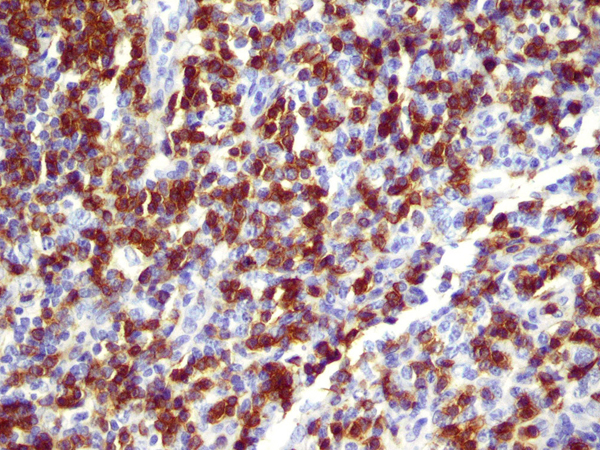 File:Angioimmunoblastic T-cell lymphoma Biopsy 3.jpg