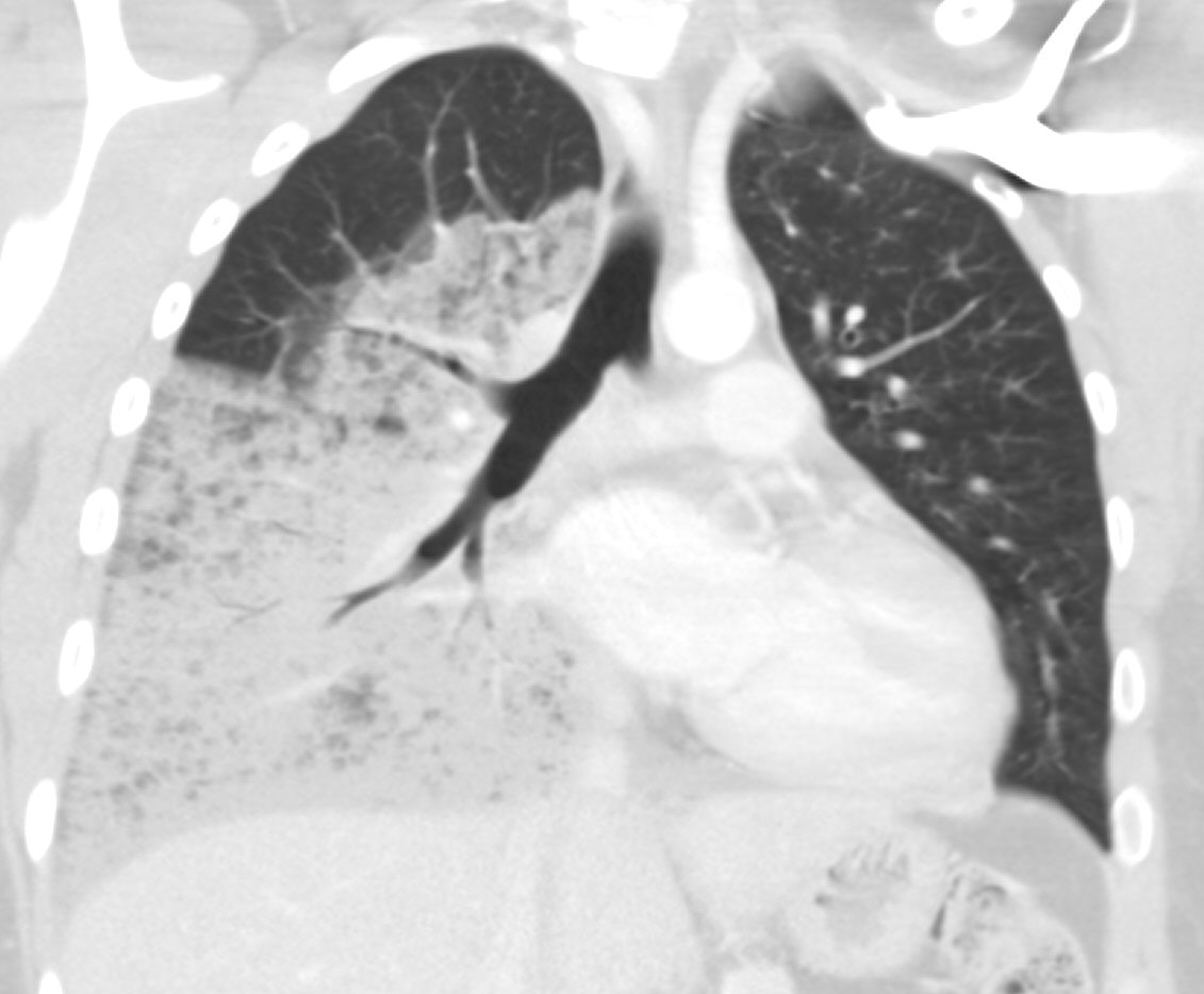 CT: Another patient with bronchoalveolar carcinoma (Image courtesy of RadsWiki)