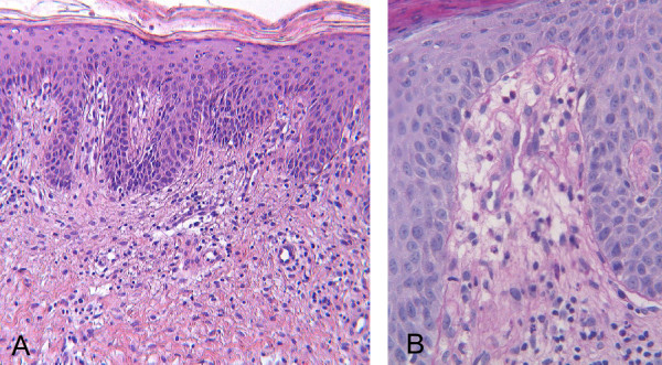 A) Psoriasiform hyperplasia of the epidermis with overlying parakeratosis and mild perivascular infiltrate of lymphocytes in the upper dermis (HE 5 X). B) Vascular dilatation (HE 20 X).[9]