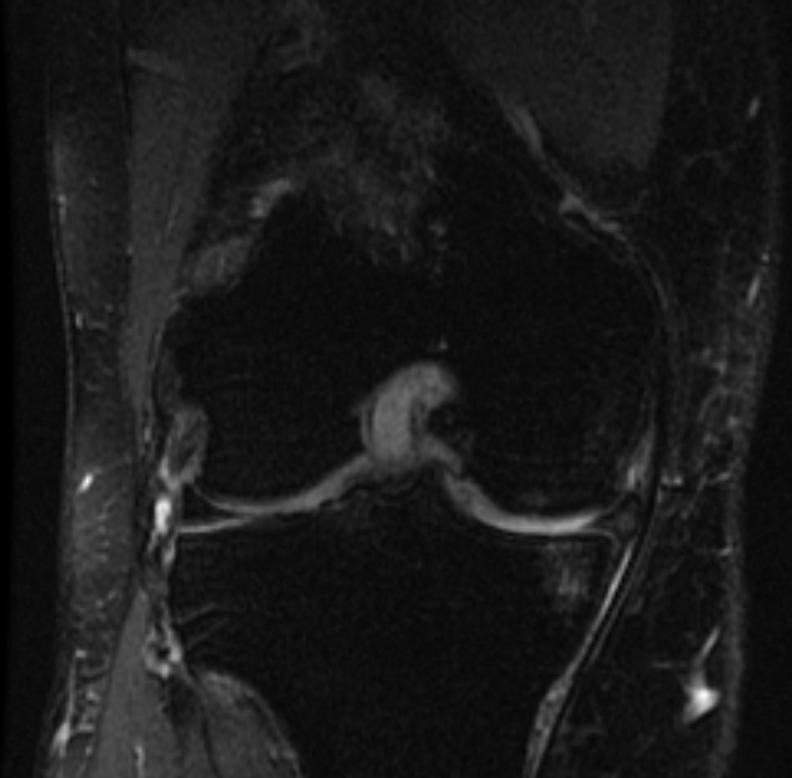 File:Mucoid degeneration of the anterio cruciate ligament MRI 004.jpg