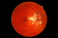 File:Presumed ocular histoplasmosis syndrome-11192007.png