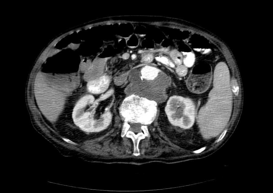 File:Tuberculosis paraspinal abscess MRI 001.jpg